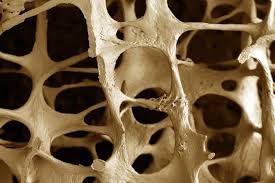 usaha kesembuhan osteoporosisi
